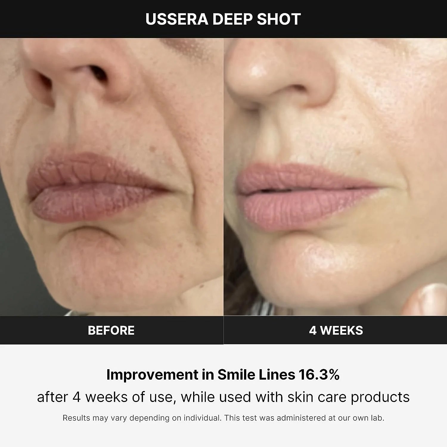 Age-R USSERA Facial Treatment Device - At-Home Skin Care Device for Collagen Stimulation Wrinkle Reduction, and Youthful Complexion - Korean Skin Care