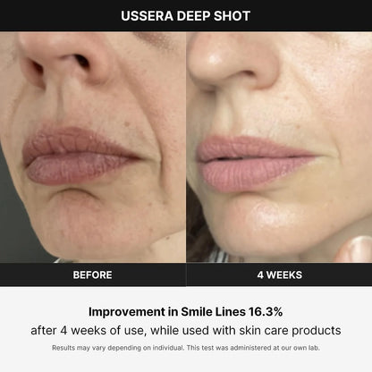 Age-R USSERA Facial Treatment Device - At-Home Skin Care Device for Collagen Stimulation Wrinkle Reduction, and Youthful Complexion - Korean Skin Care